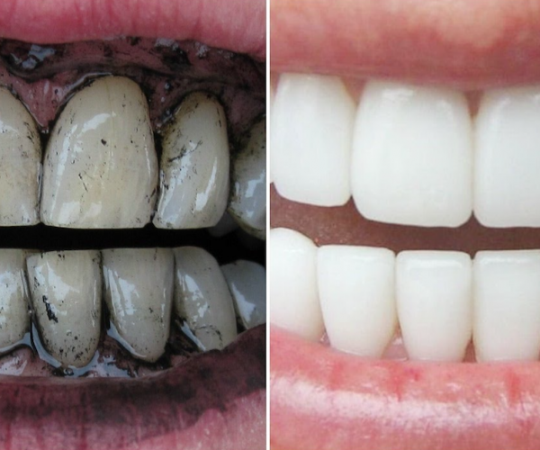 Activated Charcoal Teeth Whitening Powder