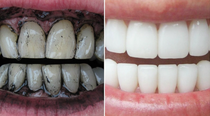 Activated Charcoal Teeth Whitening Powder